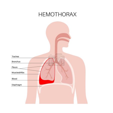 Hämothorax-Erkrankung. Das Blut sammelt sich in der Pleurahöhle. Lungenkollaps, Versagen und Unordnung. Starker Husten, Brustschmerzen, Atembeschwerden. Ungesunde innere Organe. Illustration der Atemwege