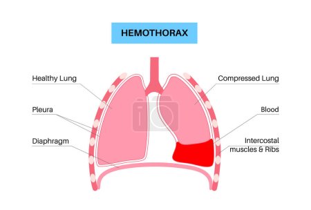 Téléchargez les illustrations : Maladie de l'hémothorax. Le sang s'accumule dans la cavité pleurale. Affaissement des poumons, échec et désordre. Toux sévère, douleurs thoraciques, difficultés respiratoires. Organes internes malsains. Illustration du système respiratoire - en licence libre de droit