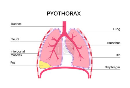 Pyothorax and pleural empyema. Lungs inflammatory disease. Infection in chest cavity and heart area. Chest pain, difficulty breathing. Unhealthy internal organ. Pus or bacteria in respiratory system
