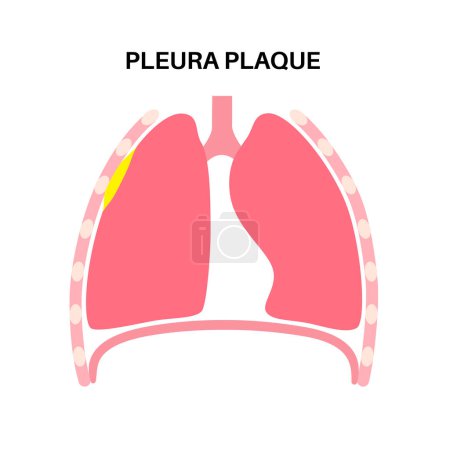 Illustration for Pleural plaque medical poster. Asbestos related lungs disease. Thickened tissue in the human body, respiratory system illness. Difficulty breathing, bloody cough, chest pain flat vector illustration. - Royalty Free Image