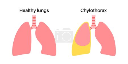 Illustration for Chylothorax disease. Lymphatic fluid between layers of tissue in lungs and chest wall. Severe cough, chest pain, difficulty breathing. Unhealthy internal organs. Respiratory system vector illustration - Royalty Free Image