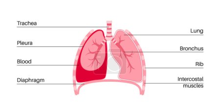 Illustration for Hemothorax disease.Blood collects in pleural cavity. Lungs collapse, failure and disorder. Severe cough, chest pain, difficulty breathing. Unhealthy internal organs. Respiratory system illustration - Royalty Free Image
