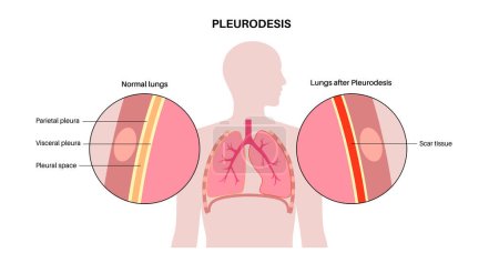Illustration for Chemical pleurodesis medical poster. Treats malignant pleural effusions by injecting a chemical substance into the pleural cavity. Scar tissue in pleural space. Lung diseases flat vector illustration - Royalty Free Image