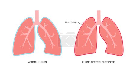 Illustration for Chemical pleurodesis medical poster. Treats malignant pleural effusions by injecting a chemical substance into the pleural cavity. Scar tissue in pleural space. Lung diseases flat vector illustration - Royalty Free Image