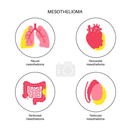 Téléchargez les illustrations : Types de tumeur mésothéliome. Cellules cancéreuses se propageant dans les poumons, le cœur, l'intestin et les testicules. Mésothéliome pleural, péricardique, péritonéal et testiculaire. Illustration vectorielle des maladies liées à l'amiante - en licence libre de droit