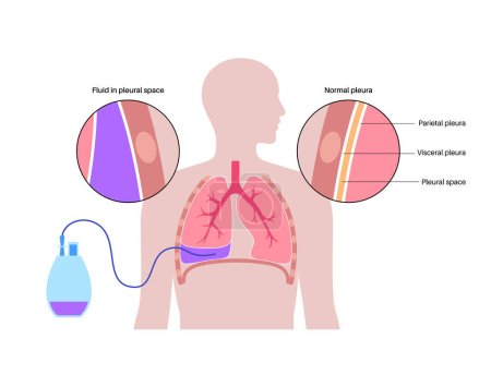 Tunneled pleural catheter system. Ambulatory pleural drainage concept. Managing of shortness of breath from recurrent malignant pleural effusions Tube drain in compressed or collapsed lung flat vector
