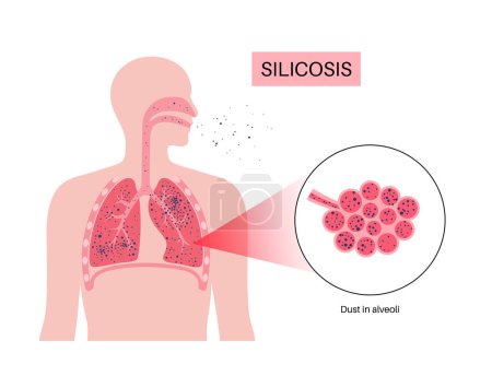 Silicosis anatomical poster. Lung disease, inhaling large amounts of crystalline silica dust. Shortness of breath, chest pain. Breathing problem, illness of respiratory system vector illustration.