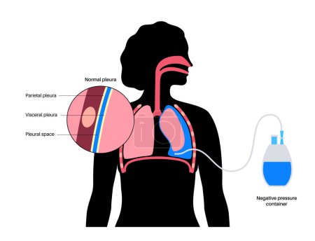 Illustration for Tunneled pleural catheter system. Ambulatory pleural drainage concept. Managing of shortness of breath from recurrent malignant pleural effusions Tube drain in compressed or collapsed lung flat vector - Royalty Free Image