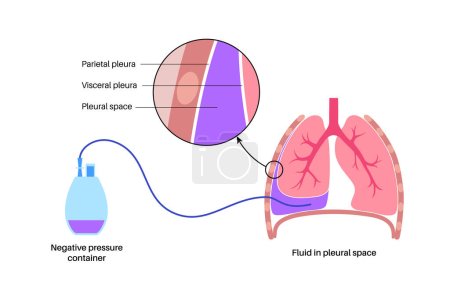 Illustration for Tunneled pleural catheter system. Ambulatory pleural drainage concept. Managing of shortness of breath from recurrent malignant pleural effusions Tube drain in compressed or collapsed lung flat vector - Royalty Free Image