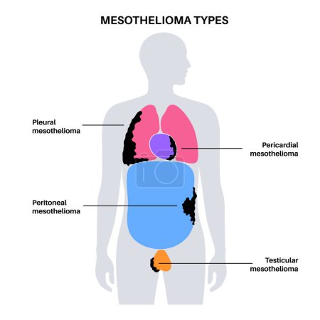 Ilustración de Tipos de tumor de mesotelioma. Células cancerosas diseminadas en pulmón, corazón, intestino y testículos. Mesotelioma pleural, pericárdico, peritoneal y testicular. Enfermedades relacionadas con el amianto vector ilustración - Imagen libre de derechos