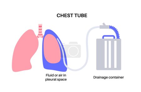 Ilustración de Tubo torácico o concepto de catéter torácico. La toracostomía por sonda drena el líquido o el aire del pulmón comprimido o colapsado. Pus o sangre en el espacio pleural. Órgano insalubre, enfermedad respiratoria vector plano - Imagen libre de derechos