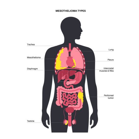 Types of mesothelioma tumor. Cancer cells spreading in lung, heart, intestine and testicles. Pleural, pericardial, peritoneal and testicular mesothelioma. Asbestos related diseases vector illustration