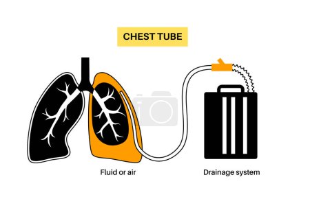 Illustration for Chest tube or thoracic catheter concept. Tube thoracostomy drain fluid or air from compressed or collapsed lung. Pus or blood in pleural space. Unhealthy organ, respiratory system disease flat vector - Royalty Free Image