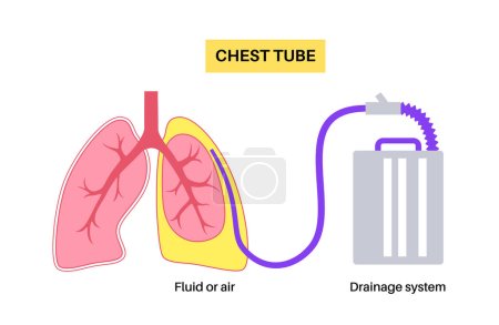 Illustration for Chest tube or thoracic catheter concept. Tube thoracostomy drain fluid or air from compressed or collapsed lung. Pus or blood in pleural space. Unhealthy organ, respiratory system disease flat vector - Royalty Free Image