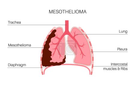 Cartel de células tumorales de mesotelioma. Concepto de cáncer de pulmón. Enfermedad del aparato respiratorio. Enfermedades relacionadas con el amianto. Dificultad para respirar, dolor en el pecho, problemas respiratorios, ilustración de vectores planos médicos.