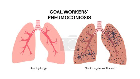Illustration for Coal workers disease concept, pneumoconiosis medical poster. CWP or black lung occupational illness, coal mine dust in the respiratory system. Shortness of breath, chest pain flat vector illustration. - Royalty Free Image