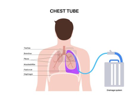 Ilustración de Tubo torácico o concepto de catéter torácico. La toracostomía por sonda drena el líquido o el aire del pulmón comprimido o colapsado. Pus o sangre en el espacio pleural. Órgano insalubre, enfermedad respiratoria vector plano - Imagen libre de derechos