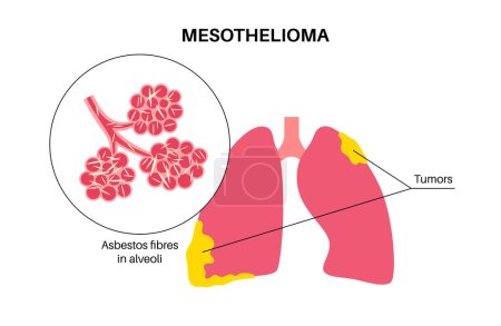 Mesothelioma tumor cells poster. Lung cancer concept. Respiratory system illness. Asbestos related diseases. Shortness of breath, pain in chest, breathing problem, medical flat vector illustration.