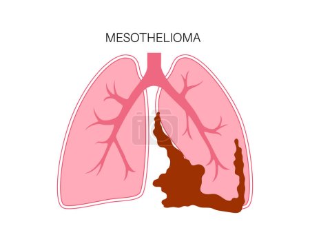 Cartel de células tumorales de mesotelioma. Concepto de cáncer de pulmón. Enfermedad del aparato respiratorio. Enfermedades relacionadas con el amianto. Dificultad para respirar, dolor en el pecho, problemas respiratorios, ilustración de vectores planos médicos.