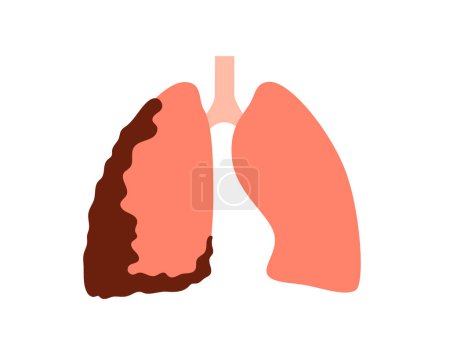 Illustration for Mesothelioma tumor cells poster. Lung cancer concept. Respiratory system illness. Asbestos related diseases. Shortness of breath, pain in chest, breathing problem, medical flat vector illustration. - Royalty Free Image