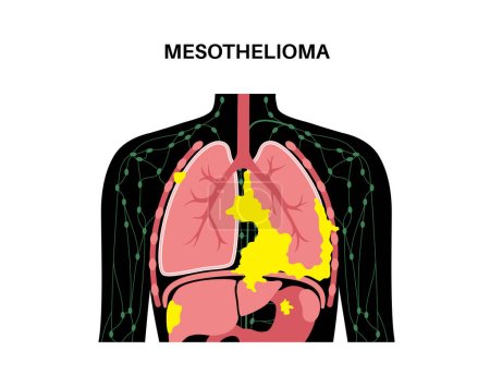 Téléchargez les illustrations : Affiche sur les cellules tumorales du mésothéliome. Concept de cancer du poumon. Maladie respiratoire. Maladies liées à l'amiante. Essoufflement, douleur thoracique, problème respiratoire, illustration du vecteur plat médical. - en licence libre de droit