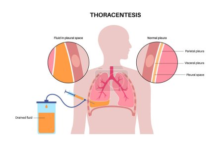 Illustration for Thoracentesis procedure medical poster. Obtain fluid from space around the compressed lung. Incision of the chest wall. Unhealthy internal organs, respiratory system disease flat vector illustration - Royalty Free Image