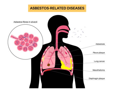 Asbestos related diseases. Pleura and diaphragm plaque, lung cancer, asbestosis, and mesothelioma tumor cells. Respiratory system illness. Shortness of breath, pain in chest flat vector illustration.
