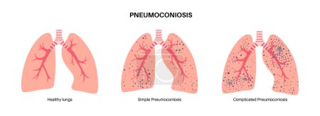 Illustration for Pneumoconiosis, asbestosis and silicosis. Coal workers disease, CWP or black lung occupational illness, coal mine dust or asbestos in the respiratory system. Shortness of breath, chest pain vector - Royalty Free Image
