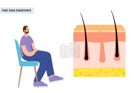 Illustration for Hair loss problems and treatment. Cartoon man character with balding head. Skin layers diagram, epidermis and dermis medical poster. Androgenetic alopecia, male pattern baldness vector illustration - Royalty Free Image