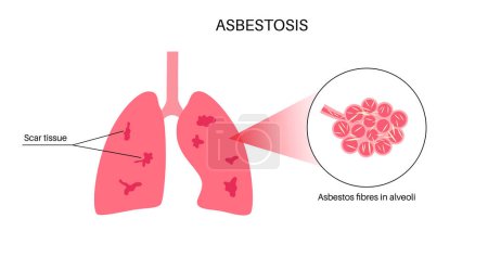 Téléchargez les illustrations : Affiche anatomique sur l'asbestose. Concept de maladie pulmonaire, fibres d'amiante. Tissu pulmonaire cicatrisant et essoufflement, douleur thoracique. Problème respiratoire, maladie du système respiratoire illustration vectorielle. - en licence libre de droit