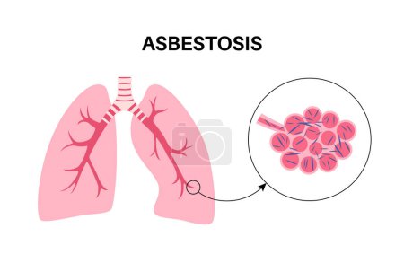 Téléchargez les illustrations : Affiche anatomique sur l'asbestose. Concept de maladie pulmonaire, fibres d'amiante. Tissu pulmonaire cicatrisant et essoufflement, douleur thoracique. Problème respiratoire, maladie du système respiratoire illustration vectorielle. - en licence libre de droit