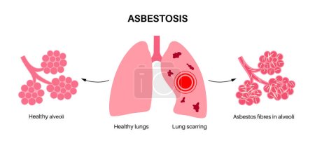 Asbestosis anatomisches Plakat. Lungenkrankheiten, Asbestfasern. Vernarbungen des Lungengewebes und Atemnot, Schmerzen in der Brust. Atembeschwerden, Erkrankungen des Atemwegsvektors Illustration.