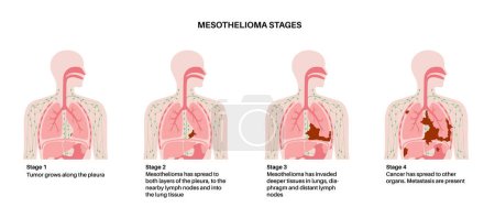 Illustration for Lung cancer stages, mesothelioma tumor cells spreading. Respiratory system illness. Asbestos related diseases. Shortness of breath, pain in chest, breathing problem, medical flat vector illustration. - Royalty Free Image