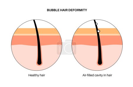 Illustration for Bubble hair deformity. Head disease, normal and unhealthy hair diagram. Effect of temperature on the human hair. Skin layers diagram, epidermis, dermis and hypodermis, flat vector illustration. - Royalty Free Image