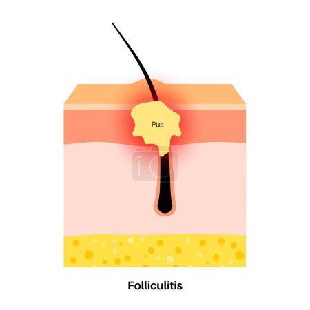 Illustration for Folliculitis medical poster. Inflamed follicles with bacteria or infection. Pimple with pus in hair follicle. Itchy, sore and painful areas. Skin layers diagram, epidermis, dermis vector illustration - Royalty Free Image
