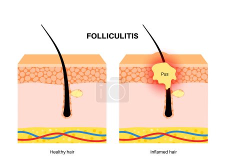 Illustration for Folliculitis medical poster. Inflamed follicles with bacteria or infection. Pimple with pus in hair follicle. Itchy, sore and painful areas. Skin layers diagram, epidermis, dermis vector illustration - Royalty Free Image