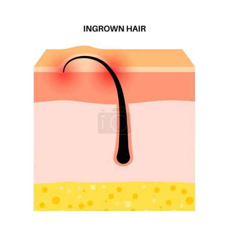 Eingewachsene Haare. Haare wachsen nach und wölben sich in die Haut. Schmerzhafte Füllungen und Entzündungen der Haut. Hautschichtdiagramm, Epidermis und Dermis medizinische Poster flache Vektorillustration