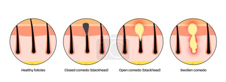 Illustration for Acne treatment. Blackheads and whiteheads, closed and inflamed comedo. Dead cells and oil from the skin clog hair follicles. Skin layers diagram, epidermis, dermis and hypodermis vector illustration. - Royalty Free Image