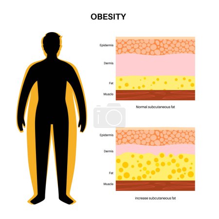 Concepto de obesidad, exceso de grasa en el cuerpo humano masculino. Celulitis y aumento del diagrama de grasa subcutánea. Silueta de hombre obeso. Estructura de las capas de piel epidermis, dermis e hipodermis ilustración vectorial plana.