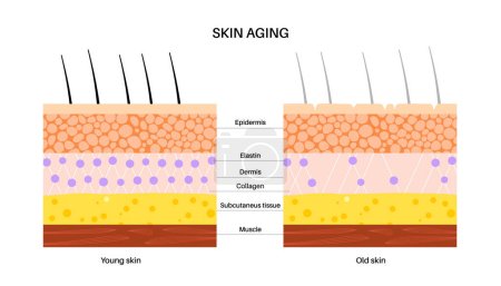 Illustrazione per Il concetto di invecchiamento della pelle. Confronto tra pelle giovane e vecchia, componenti in elastan e collagene. La pelle cambia con l'età. Rughe sul corpo nel tempo. Epidermide, derma e ipoderma illustrazione vettoriale piatta. - Immagini Royalty Free