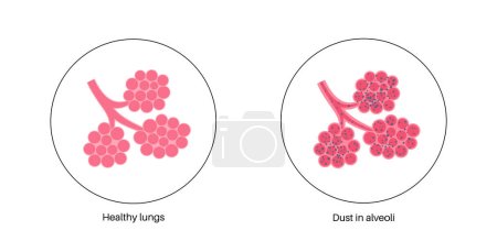 Illustration for Pneumoconiosis, asbestosis and silicosis. Coal workers disease, CWP or black lung occupational illness, coal mine dust or asbestos in the respiratory system. Shortness of breath, chest pain vector - Royalty Free Image
