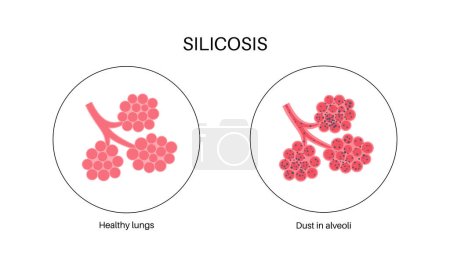 Illustration for Silicosis anatomical poster. Lung disease, inhaling large amounts of crystalline silica dust. Shortness of breath, chest pain. Breathing problem, illness of respiratory system vector illustration. - Royalty Free Image