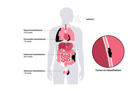 Ilustración de Tipos de tumor de mesotelioma. Células cancerosas diseminadas en pulmón, corazón, intestino y testículos. Mesotelioma pleural, pericárdico, peritoneal y testicular. Enfermedades relacionadas con el amianto vector ilustración - Imagen libre de derechos