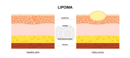 Lipoma fatty tumor medical poster. Not cancer, benign tumor under skin, fat lump in human body. Skin layers structure epidermis, dermis and hypodermis and muscle medical flat vector illustration
