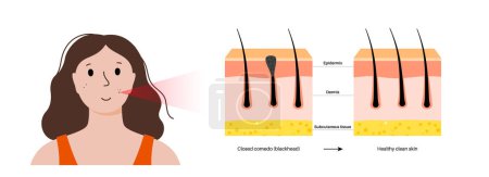 Illustration for Acne treatment concept. Dead cells and oil from the skin clog hair follicles. Blackheads and pimples, closed comedo. Skin layers diagram, epidermis, dermis and hypodermis flat vector illustration. - Royalty Free Image