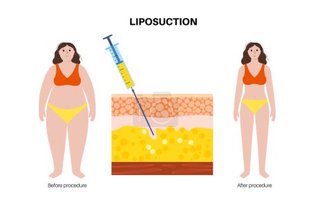 chirurgie de liposuccion, silhouette avant et après la procédure. Retirer la graisse du corps obèse. Problème d'obésité. Concept d'embonpoint. Structure des couches cutanées épiderme, derme et hypoderme illustration vectorielle