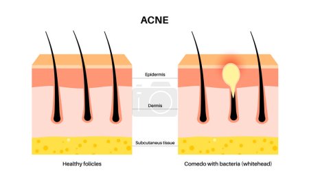 Illustration for Acne treatment concept. Dead cells and oil from the skin clog hair follicles. Whiteheads and pimples, bacteria in comedo. Skin layers diagram, epidermis, dermis and hypodermis vector illustration. - Royalty Free Image