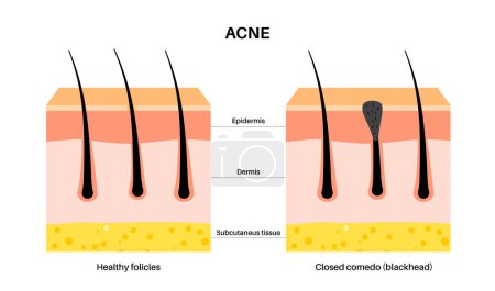 Illustration for Acne treatment concept. Dead cells and oil from the skin clog hair follicles. Blackheads and pimples, closed comedo. Skin layers diagram, epidermis, dermis and hypodermis flat vector illustration. - Royalty Free Image