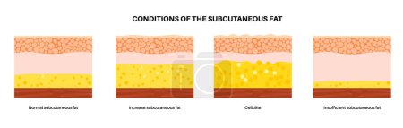 Illustration for Conditions of the subcutaneous fat in the human body. Cellulite concept, excess and insufficient fat diagram. Diet program. Skin layers structure epidermis, dermis and hypodermis vector illustration - Royalty Free Image