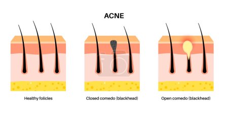 Acne treatment. Blackheads and whiteheads, closed and inflamed comedo. Dead cells and oil from the skin clog hair follicles. Skin layers diagram, epidermis, dermis and hypodermis vector illustration.